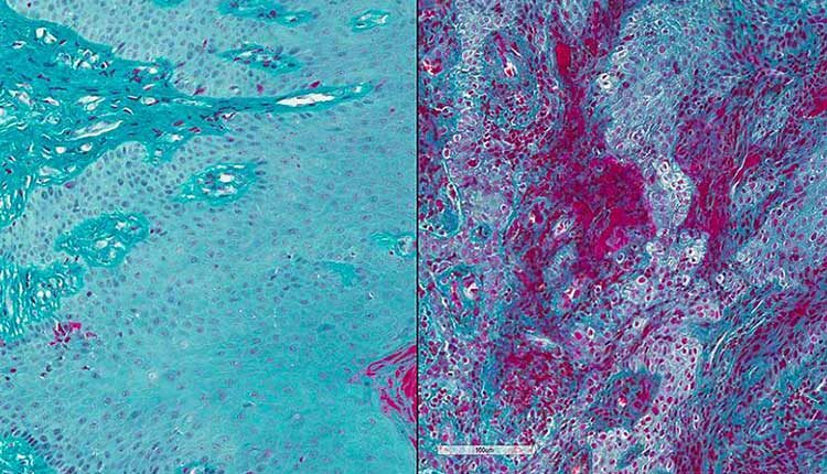 COURTESY LAKMALI SILVA, NIDCR Compared to healthy subjects (left), gingival tissue from individuals with severe periodontal disease (right) shows high levels of fibrin (magenta).