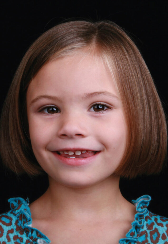 FIGURE 1.A young girl with fetal alcohol spectrum disorder.