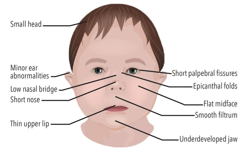 Oral Health Effects of Fetal Alcohol Spectrum Disorder - Dimensions of ...