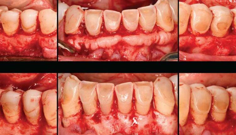 0322-crown-lengthening-9