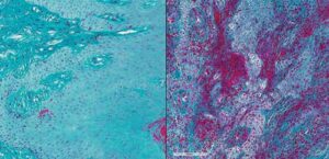 Compared to healthy subjects (left), gingival tissue from individuals with severe periodontal disease (right) shows high levels of fibrin (magenta).