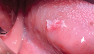 lesion close up