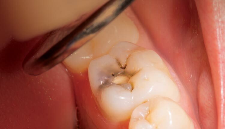 A Minimally Invasive Approach to Caries - Dimensions of Dental Hygiene