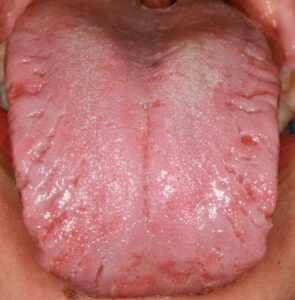 FIGURE 1. The dorsum and lateral border of the tongue exhibit deep fissures, patches of migratory glossitis, and coated papillae.
