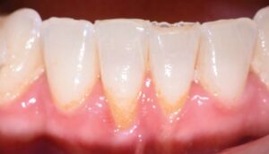 close up of teeth