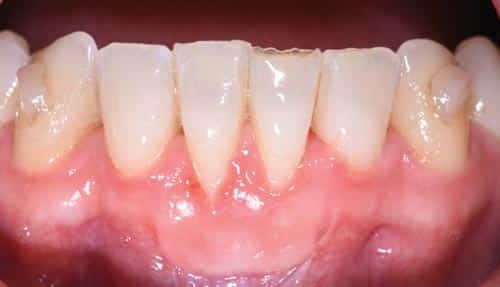 The Dental Hygienist S Role In Treating Gingival Recession Dimensions