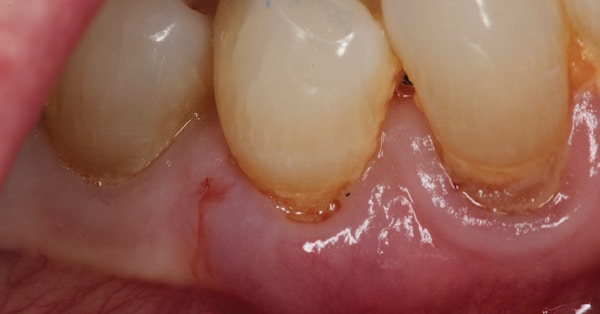 external resorption of tooth