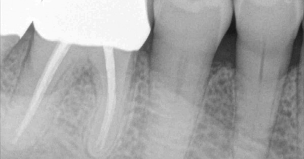 FIGURE 2. Radiograph taken 15 months prior to the recare appointment.