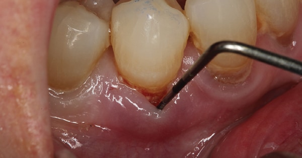 Jaw and Gum Resorption, Annapolis Specialist for Restoring Your Oral  Health