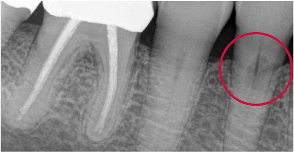 FIGURE 4. New radiograph taken at time of recare appointment. Circle shows the defect on root surface.