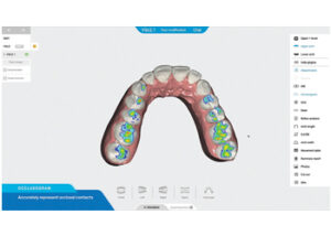 aligner software