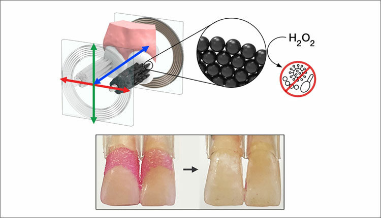 Arranged in bristle-like structures, a robotic microswarm of iron oxide nanoparticles has been shown to effectively clean plaque from teeth. The nanoparticles have both magnetic and catalytic properties that allow catalyzed hydrogen peroxide to produce free radicals that also control cariogenic pathogens.