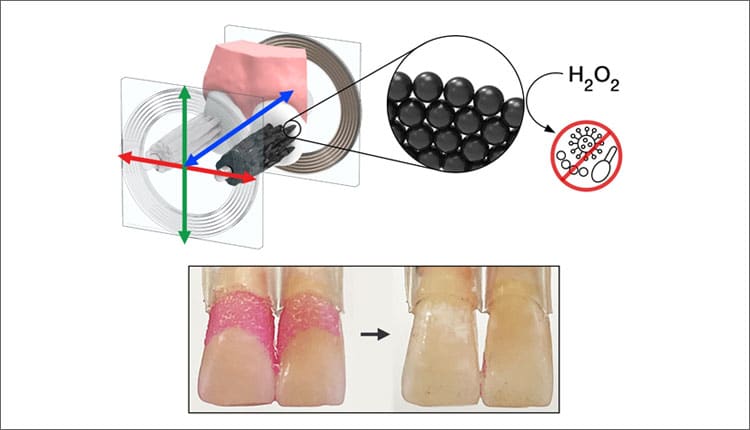 Arranged in bristle-like structures, a robotic microswarm of iron oxide nanoparticles has been shown to effectively clean plaque from teeth. The nanoparticles have both magnetic and catalytic properties that allow catalyzed hydrogen peroxide to produce free radicals that also control cariogenic pathogens.