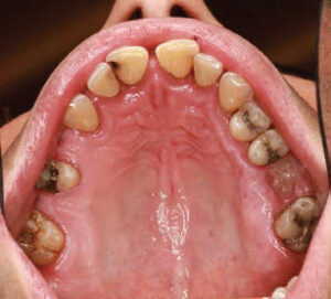 FIGURE 2. Intraoral view of initial presentation in April 2021.