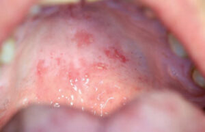 FIGURE 4. “Kissing lesion” (hard palate) on July 2021 visit.