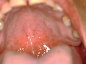 FIGURE 5. Resolution of the palatal lesion.