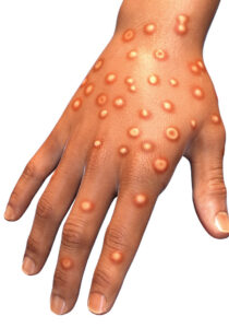 FIGURE 1. Ilustration of a monkeypox infection presenting on a patient’s hand.