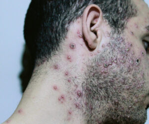 FIGURE 3. Adult man with monkeypox lesions presenting on his face.