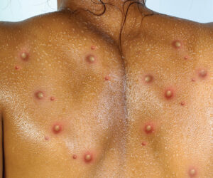 IGURE 4. An illustration of a monkeypox infection presenting on a patient’s back.