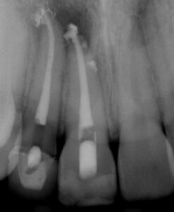 FIGURE 1A. Radiograph showing tooth #7 with an apical delta, and tooth #8 with two lateral canals.