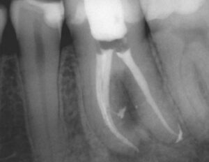 Detecting Endodontic-Periodontal Lesions - Dimensions of Dental Hygiene