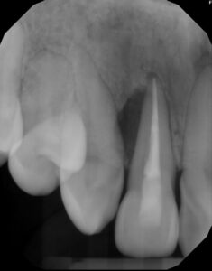 FIGURE 2A. Preoperative radiograph of previously treated tooth #7 with bone loss to the apex.