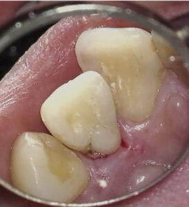 FIGURE 2B. Tooth #7 with a palatal groove.