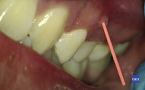 FIGURE 3A. Gutta-percha tracing of a sinus tract buccal to #13.