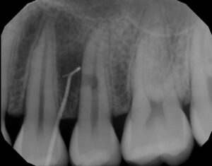 Detecting Endodontic-Periodontal Lesions - Dimensions of Dental Hygiene