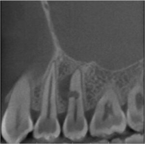FIGURE 3C. Sagittal cone-beam computed tomography showing the midroot resorption and associated radiolucency.