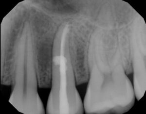 FIGURE 3D. The root canal system, which was apical to the resorption, was obturated with gutta-percha and sealer. The area of resorption was repaired with bioceramic putty. The root canal system that was coronal to the resorption was filled with composite.