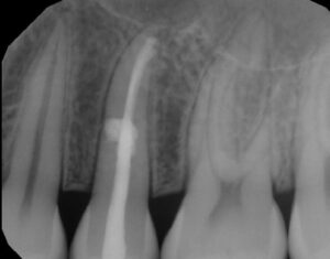 FIGURE 3E. Image showing complete healing at five months.