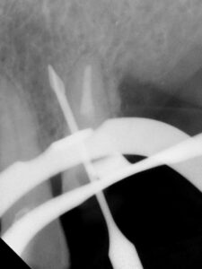 FIGURE 4. A perforation with a Gates-Glidden drill that occurred during post space preparation in the undergraduate dental clinic.