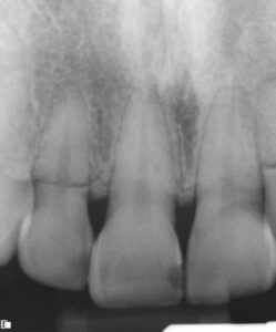 FIGURE 5. Horizontal root fracture in tooth #7 which connects the root canal system to the periodontium.