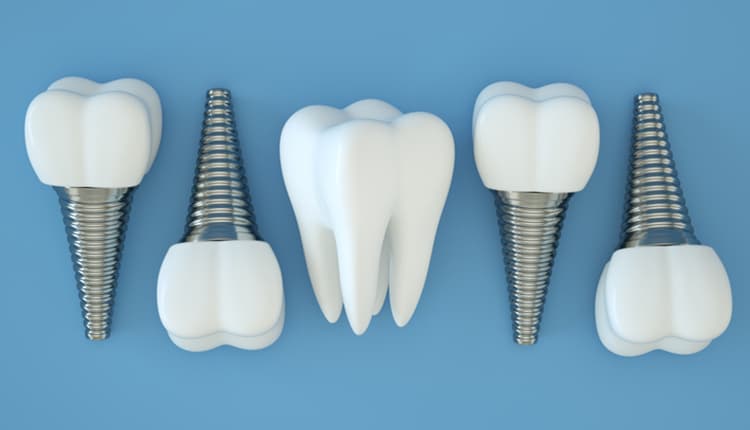 dental implants
