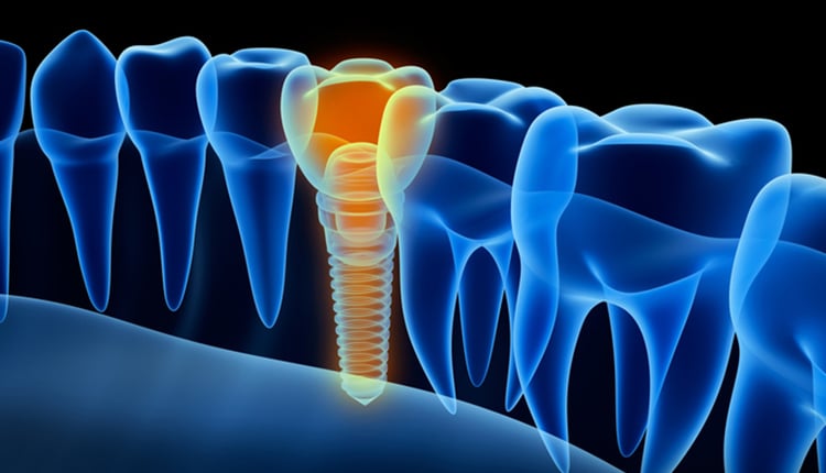 X-ray view of denture with implant. Xray view.
