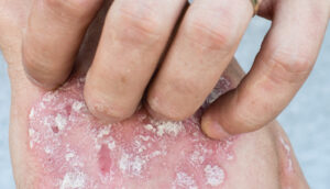 hand scratching other hand