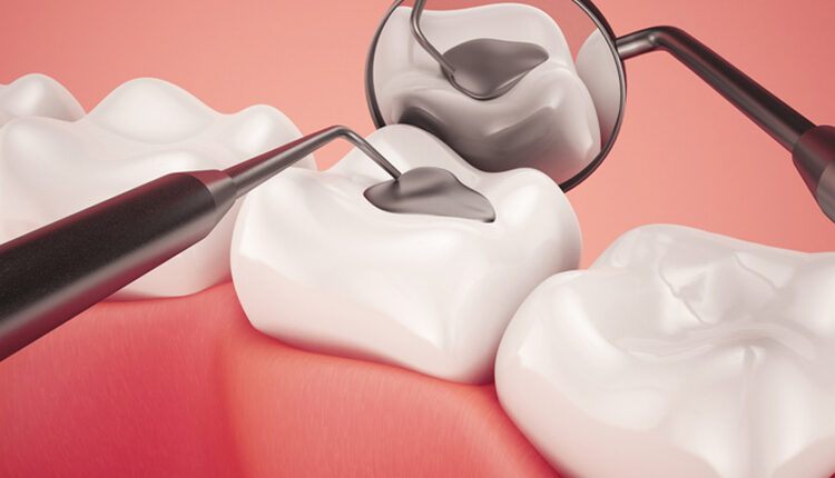 Amalgam Filling Checkup