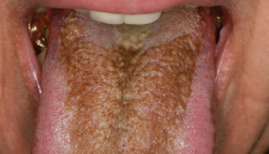 hairy tongue