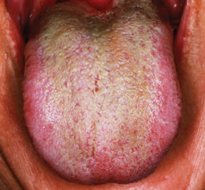 FIGURE 4A. Nine-month follow-up, June 7, 2022. The patient presented with increased elongated filiform papillae, burning pain, greentinged coloration, and recent antibiotic use.