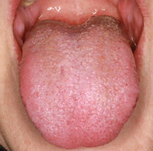 FIGURE 4B. Immediate view post third treatment. Patient expressed improvement of symptoms, including tongue burning.