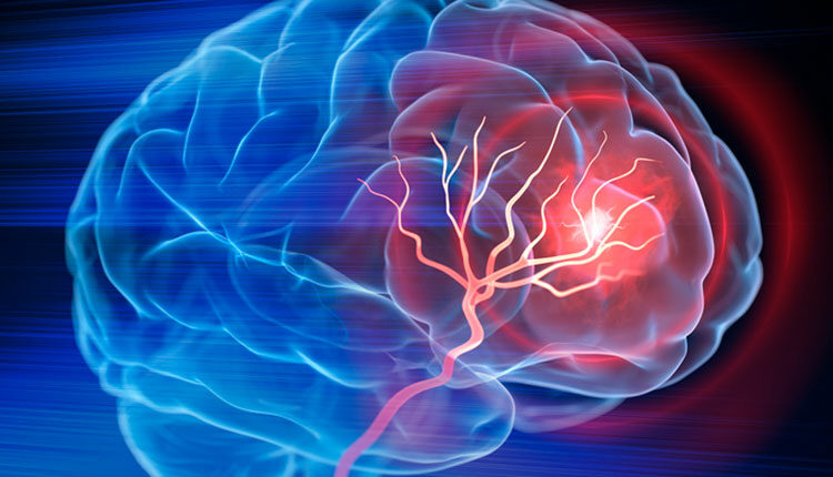 X- Ray illustration of brain stroke