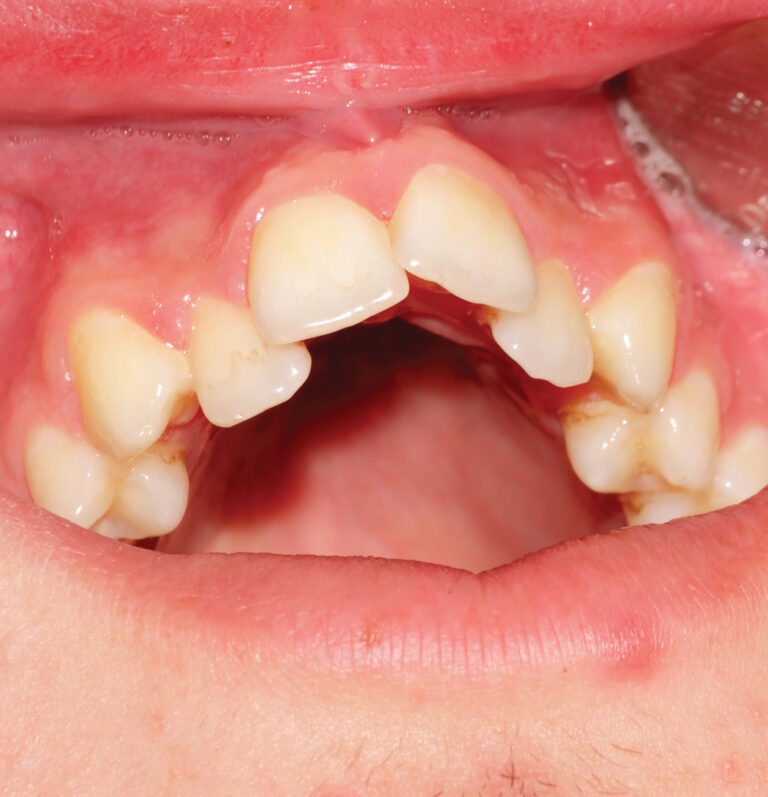 Tips to Effectively Educate Caregivers Regarding NonNutritive Sucking