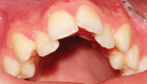 FIGURE 1. Malocclusion in a patient with secondary dentition.