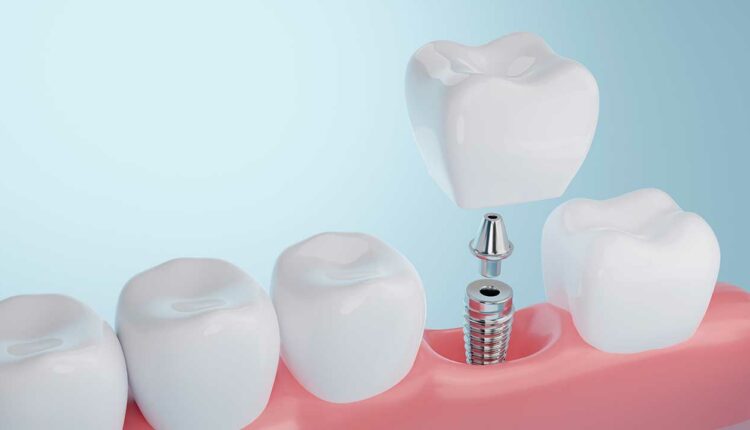 dental-implant