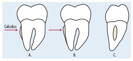 Negotiating Deep Pockets with Ultrasonics - Dimensions of Dental Hygiene