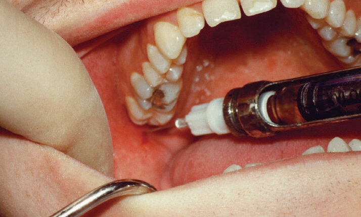 044_MandibularBlockCE_42-45-(Page-44)_Page_1_Image_0003