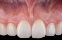 Treating Patients with Lupus - Dimensions of Dental Hygiene