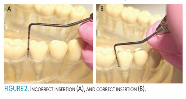The Importance of Probes in Assessing Periodontal Health - Dimensions ...