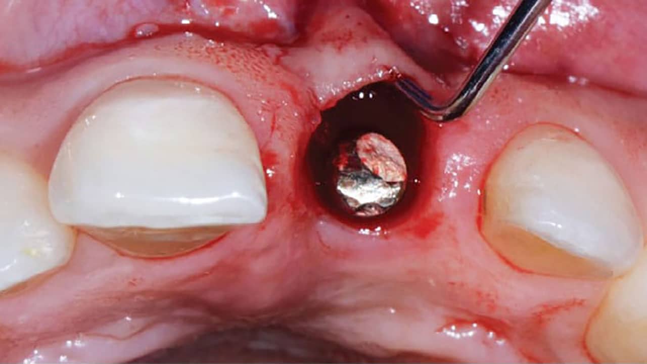 A Comprehensive Approach to Implant Soft Tissue Management
